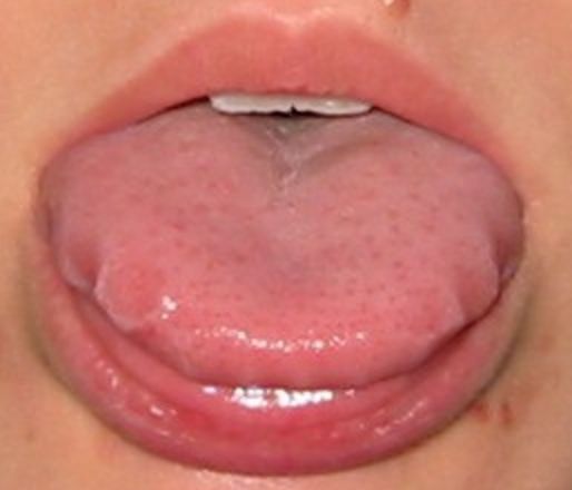 Si vous voyez ceci sur votre langue, courez voir votre medecin ...