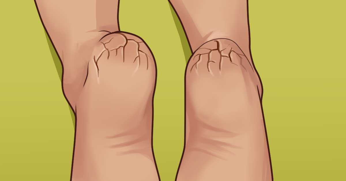 Почему ногах трещины